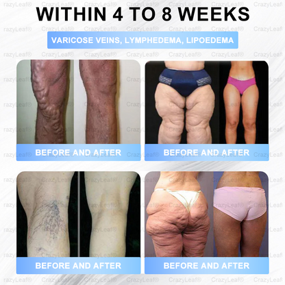 FDA Store🏥| 𝐵uil𝗱𝐿ea𝐟® 𝑺𝑀𝗚T-𝑮𝐋𝑃-1 𝐒limming & 𝐻ealth 𝑁ano 𝑀icroneedle 𝑃atch with Collagen & Matrixyl 3000 丨Obesity,Cardiovascular Diseas, Diabetes, Sleep Apnea, Joint Problems and More